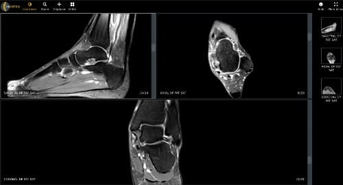 Testez ce cas d’IRM de cheville sur notre webviewer intégré !