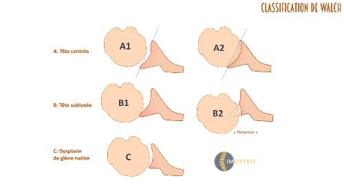 Classification de Walch de l’arthrose gléno-humérale