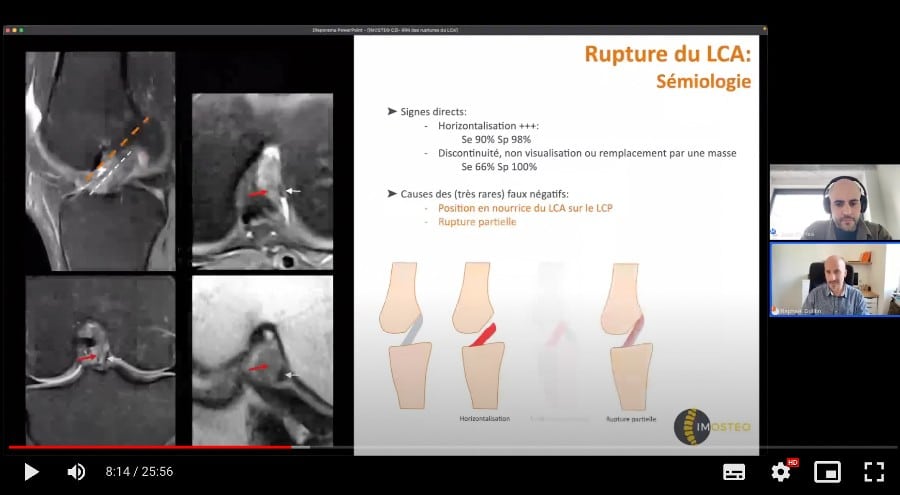 Webinaire Imosteo/ C2i sur l’IRM de la rupture du LCA